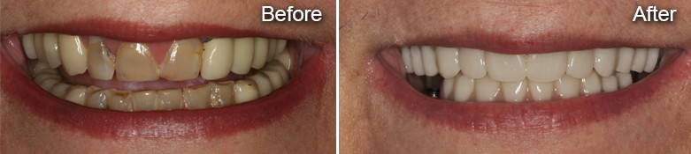custom cosmetic dentures before after