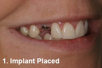 Dental Implant Placed