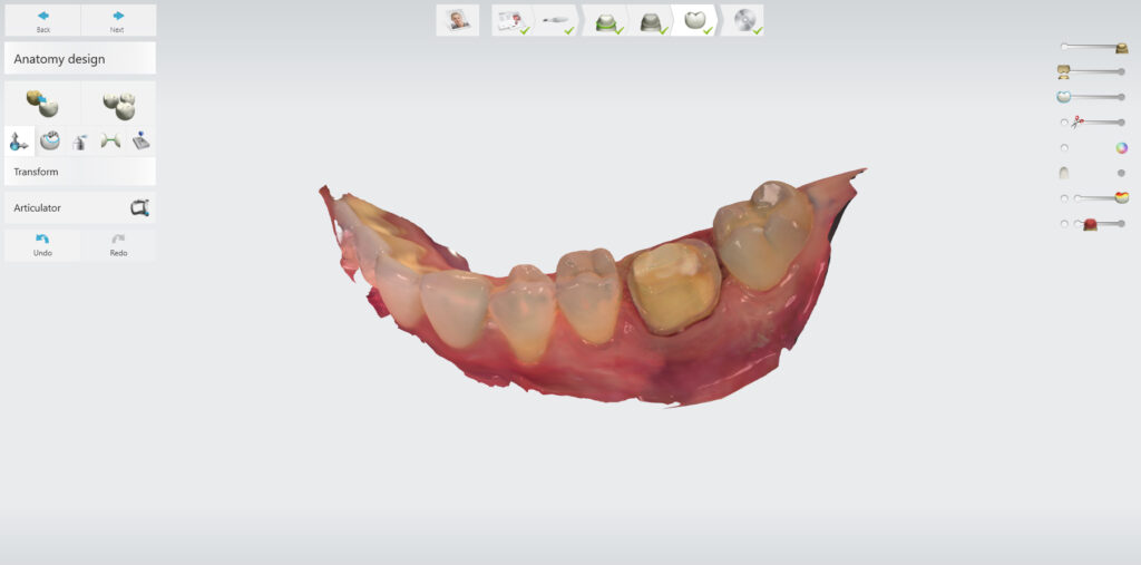 same day dentistry, Digital Scan, CAD CAM, sa