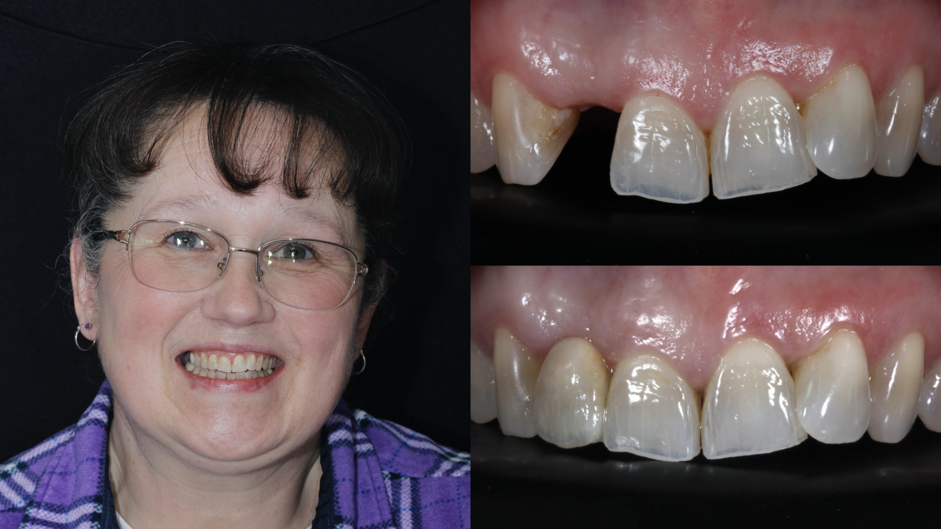 missing front tooth. maryland bridge elab protocol