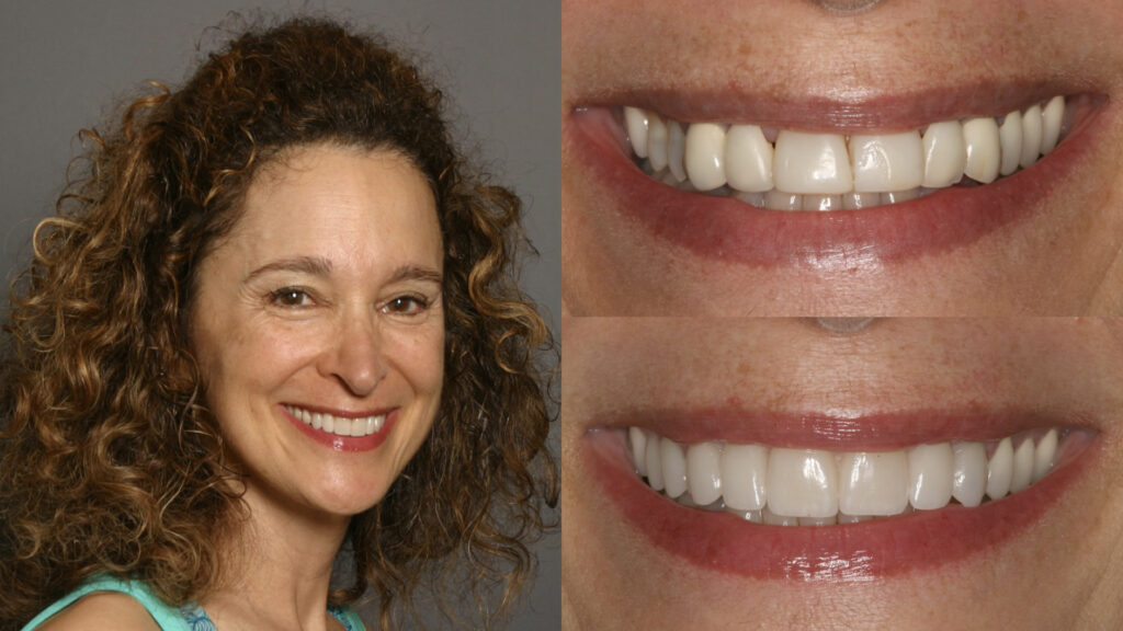 Before & After Porcelain Veneers Treatment 8