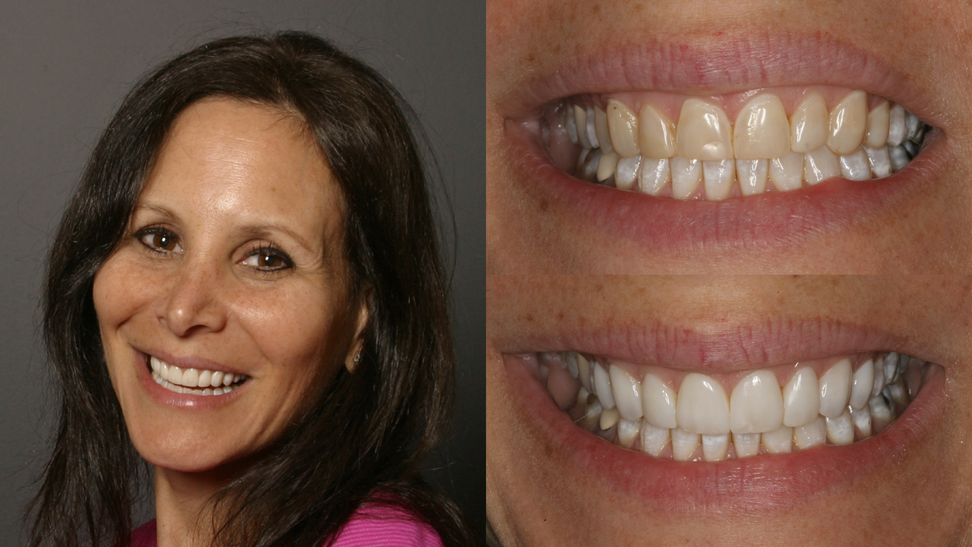 Stained Teeth. Whitening. Direct Resin Veneers