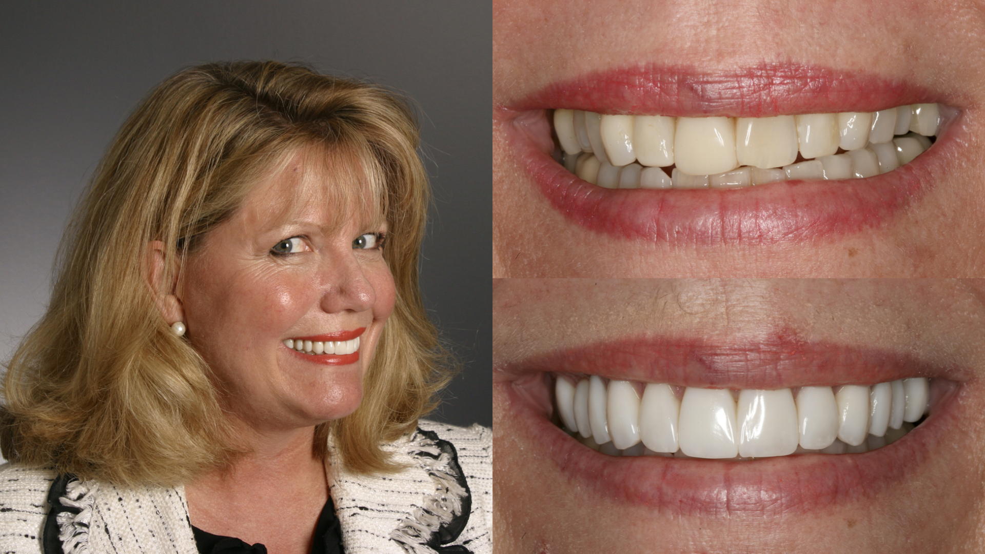 Direct Composite Bonding. Worn Discolored Crooked Teeth