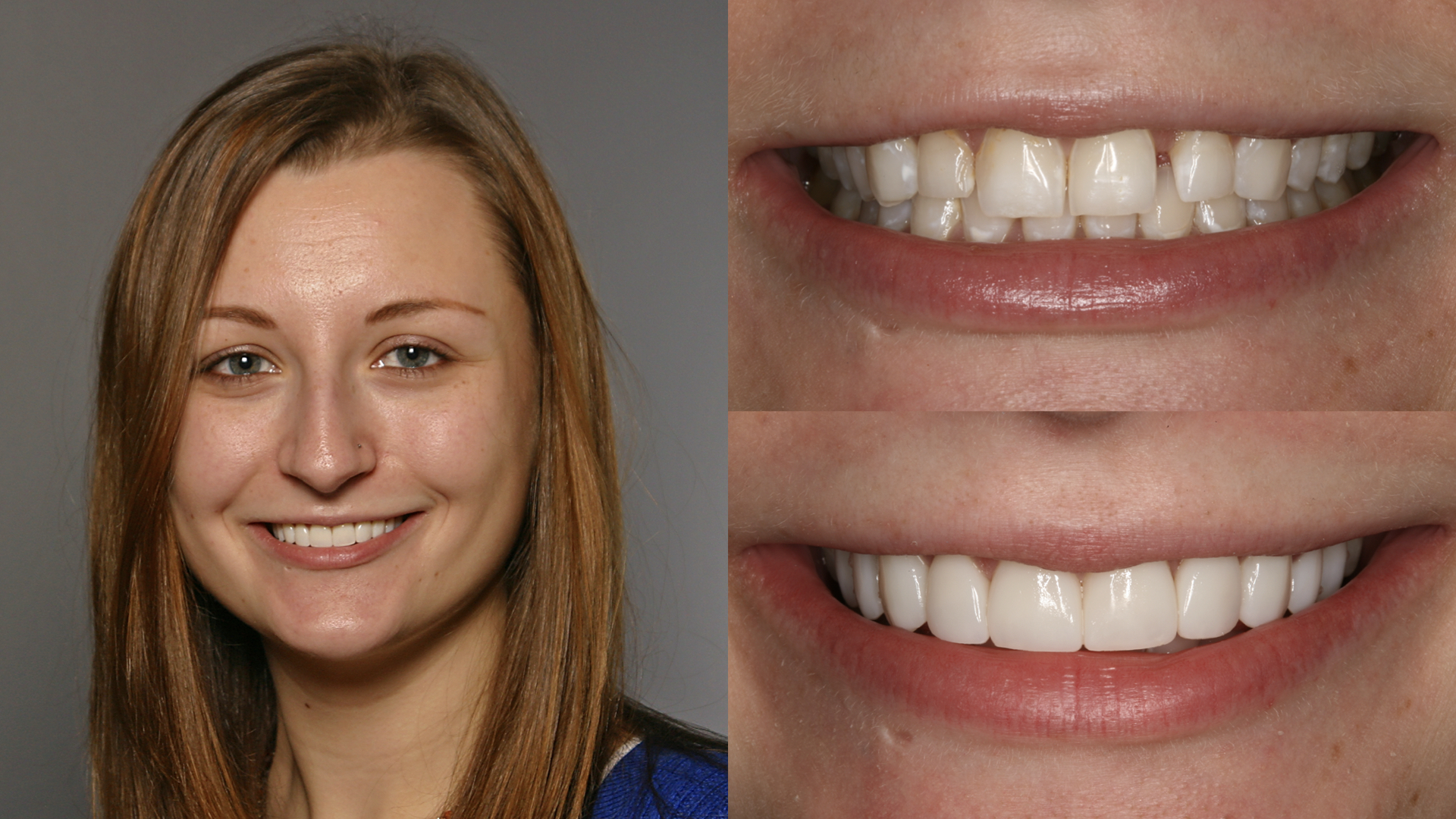 Before And After Veneers Small Teeth