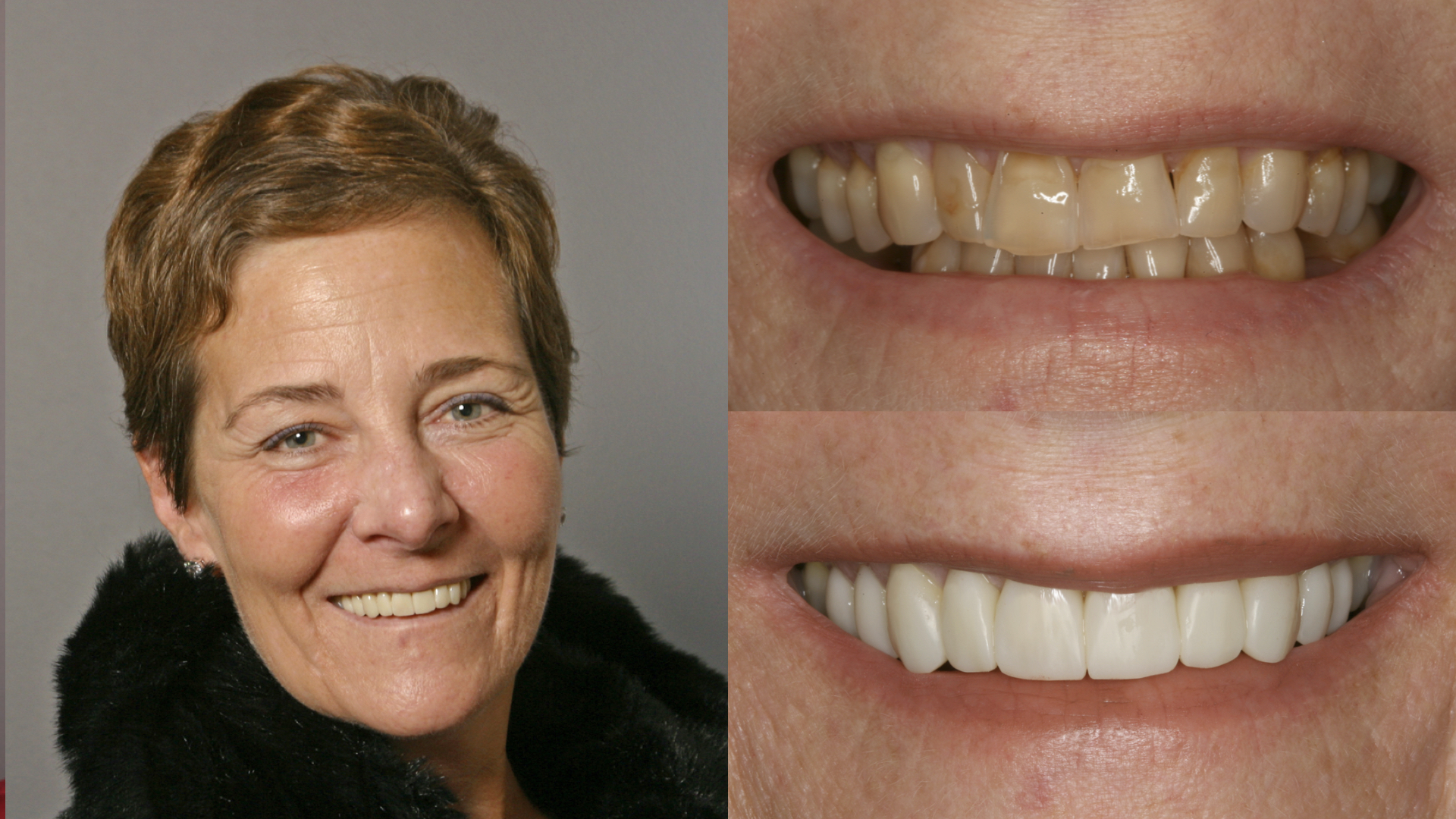Discolored Worn Teeth. Direct Resin Veneers