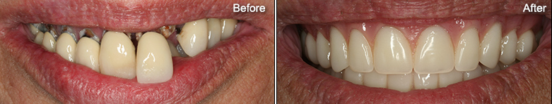 Custom Cosmetic Dentures In Glenview – Before & After