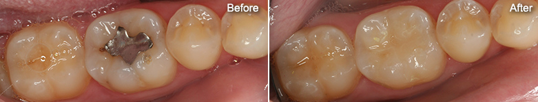 Tooth Colored Fillings In Glenview, IL