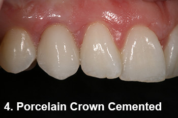 Porcelain Crown Cement