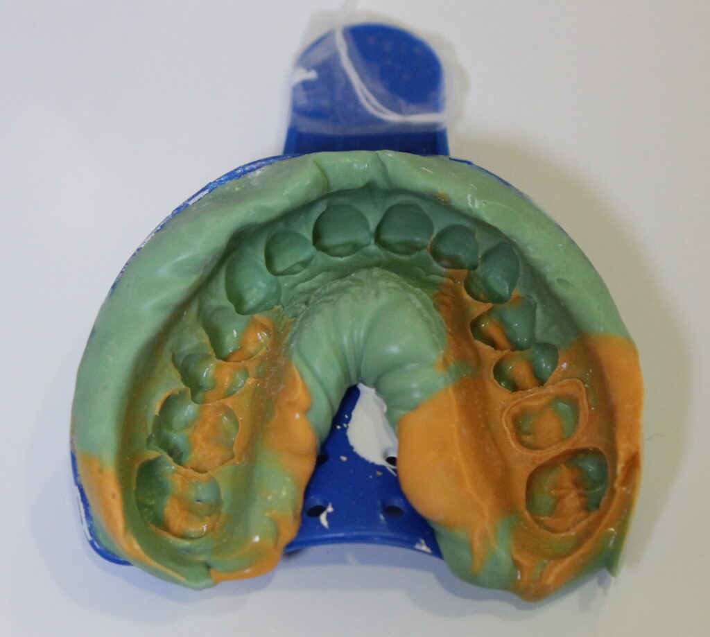 Digital vs Traditional Impressions Chicago Beautiful Smiles