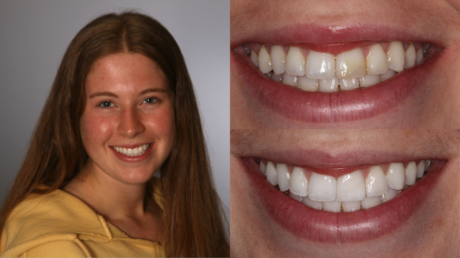 composite bonding, dental, smile