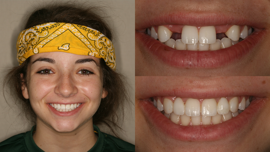 dental implant, missing teeth, smile