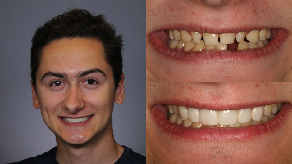 dental implant, composite bonding, bridge, smile