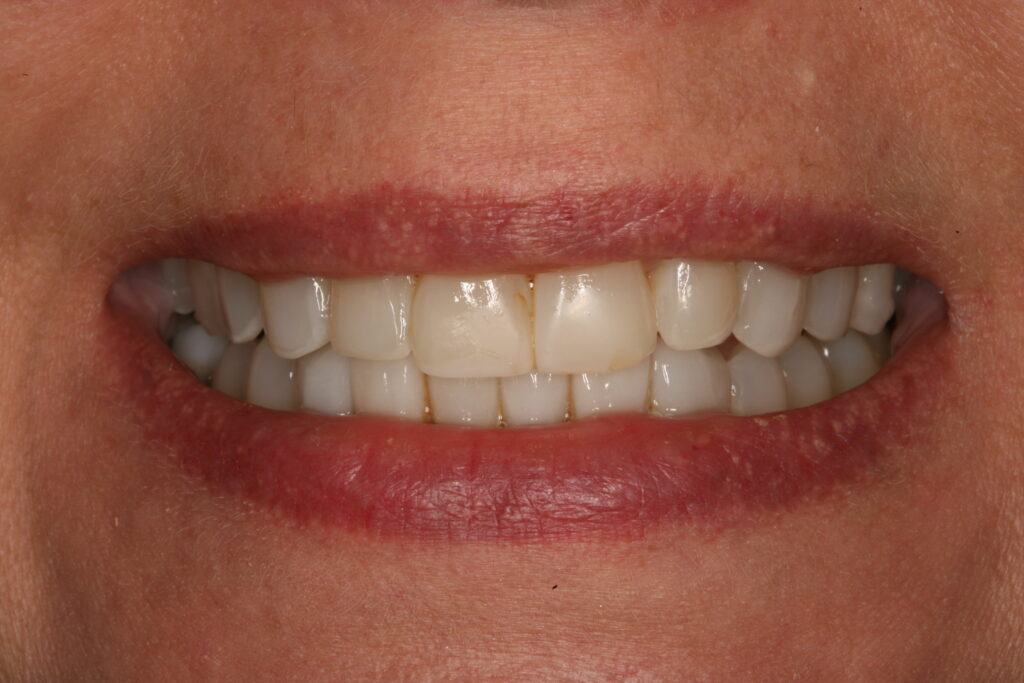 Before and After, Porcelain Veneers