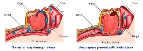 snoring, sleep apnea, sleep. open airway