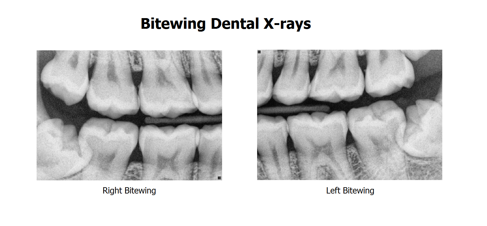 dental x-rays, x-ray, dentist, chicago