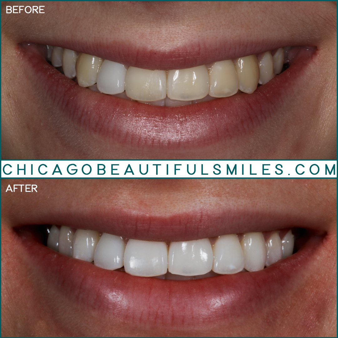 Teeth Whitening Glenview, Chicago - Side Effects & Options