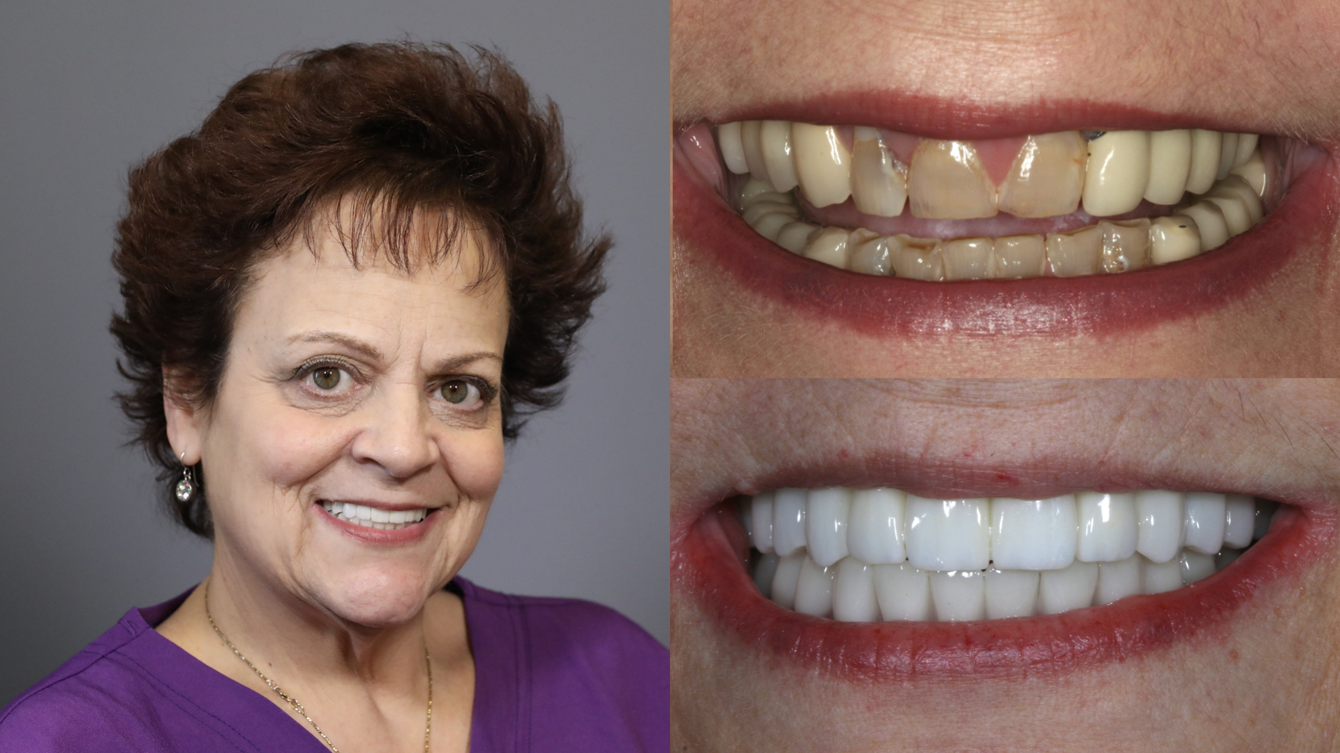 dental implants. porcelain crowns bridges. fixed hybrid