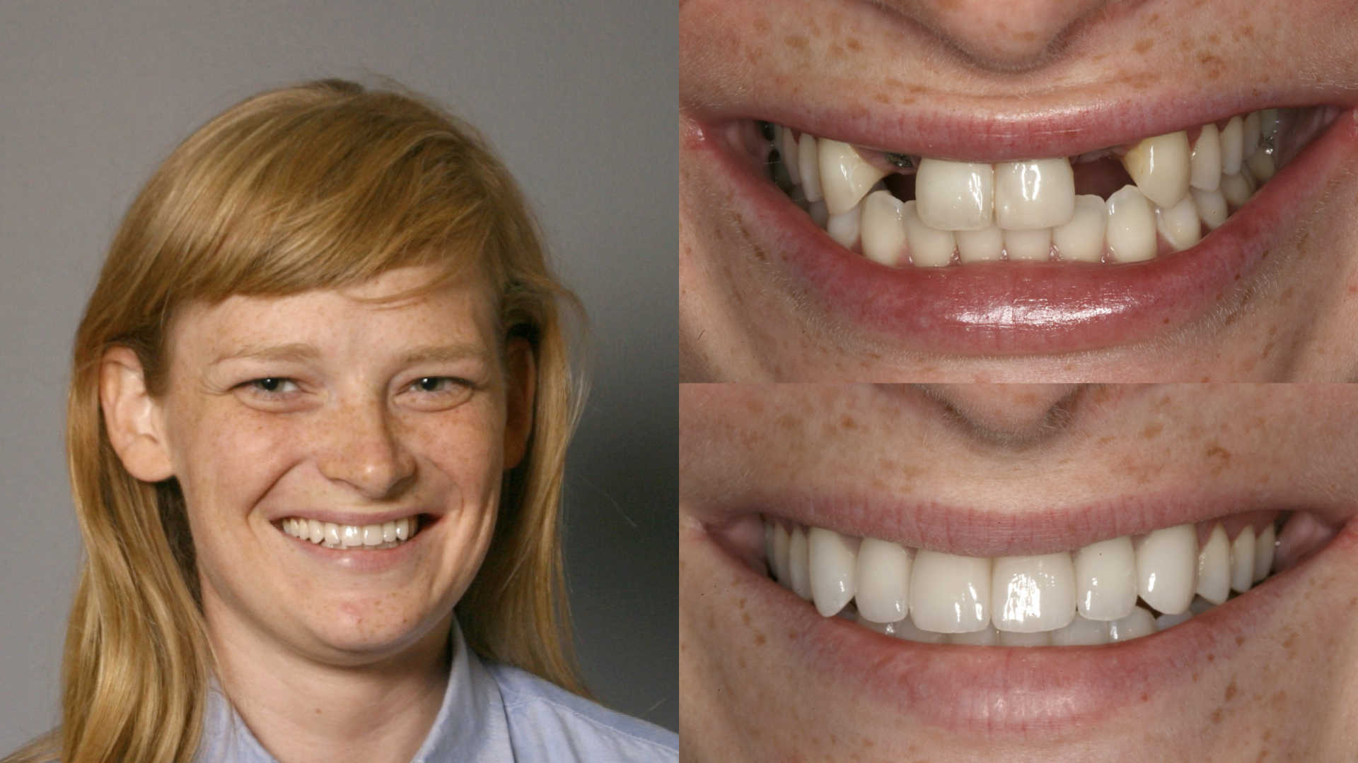 congenitally missing teeth. dental implants. porcelain crowns.