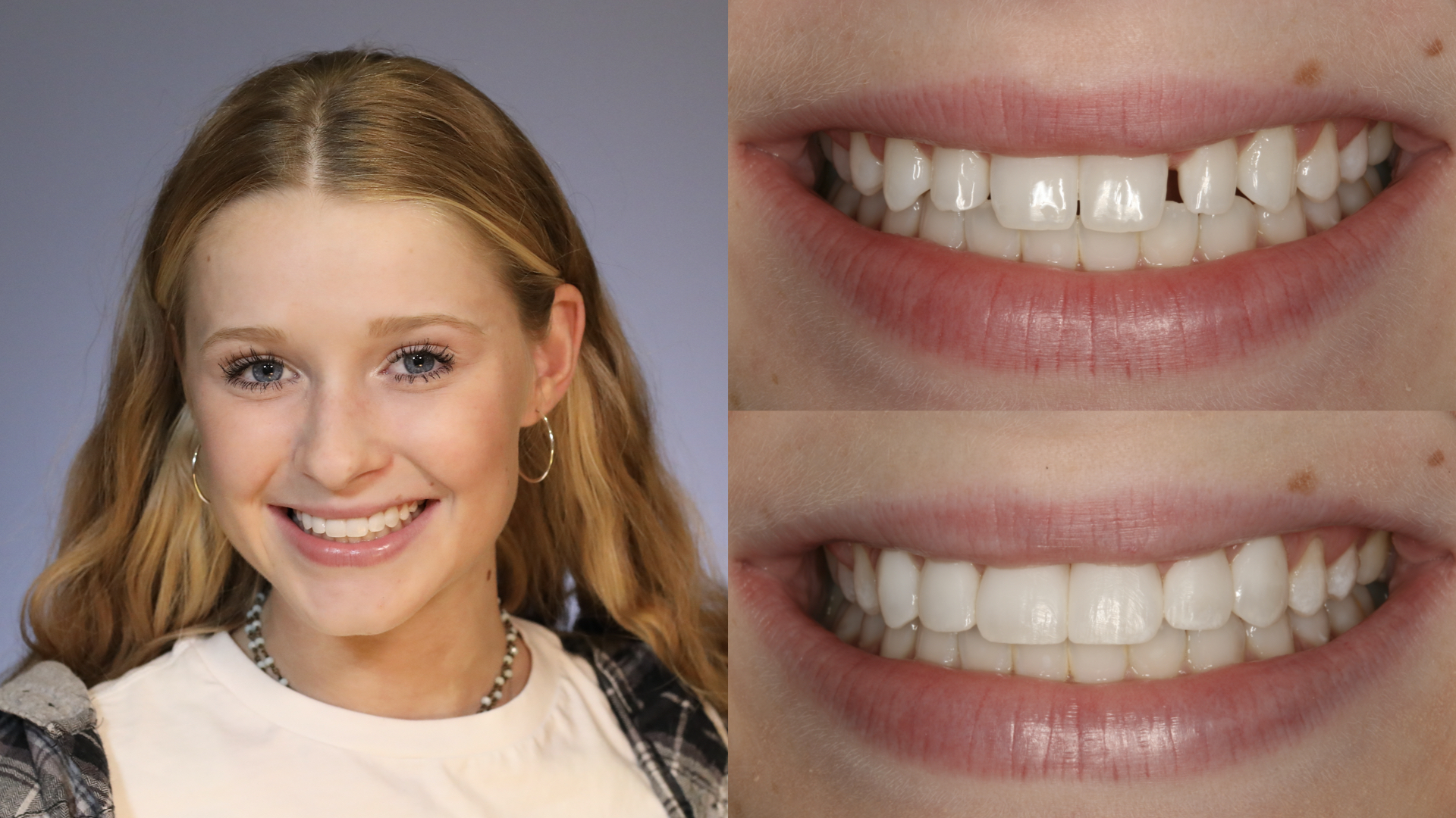 peg laterals. small teeth. direct resin veneers