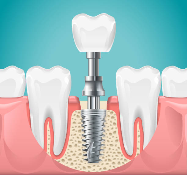 An illustration depicts a dental implant where the replacement tooth is being screwed into the implant, located between two natural teeth
