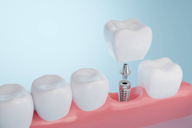 Dental Implants in Glenview, IL