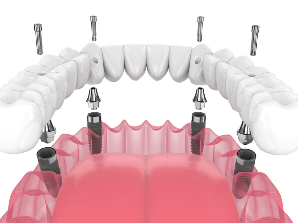 Dental Implants Winnetka, IL