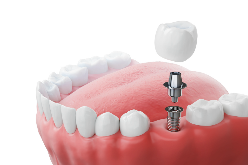 A complete dental implant in the lower arch of teeth, showing the implant in the gum, the abutment, and the crown.