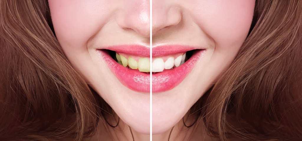 Before and after iages of woman's smile fixed with veneers. 