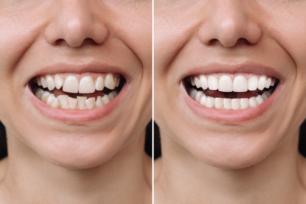 Before and after image of composite bonding.