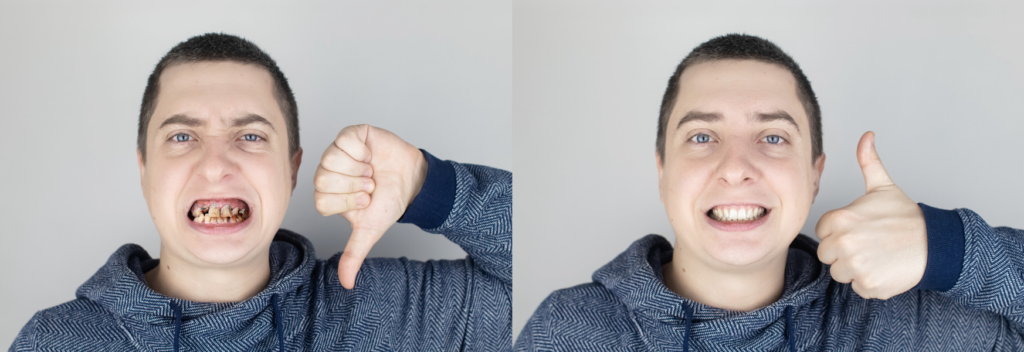 Before and after images of man's smile fixed with veneers. 