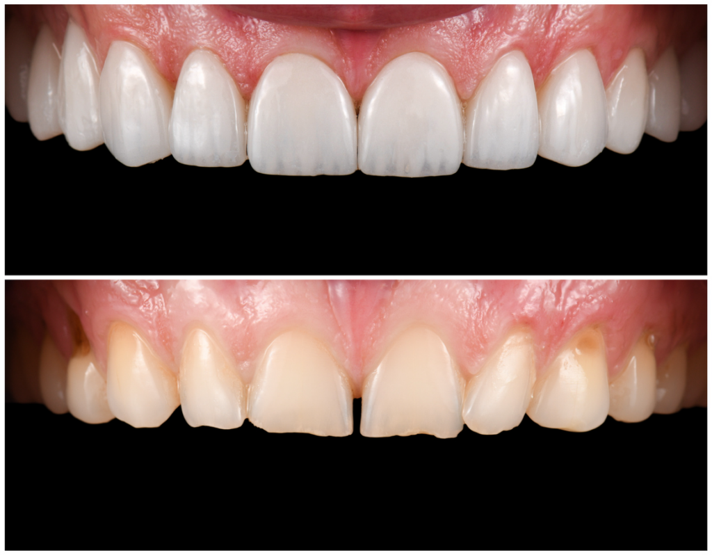 Before and after image of composite bonding.